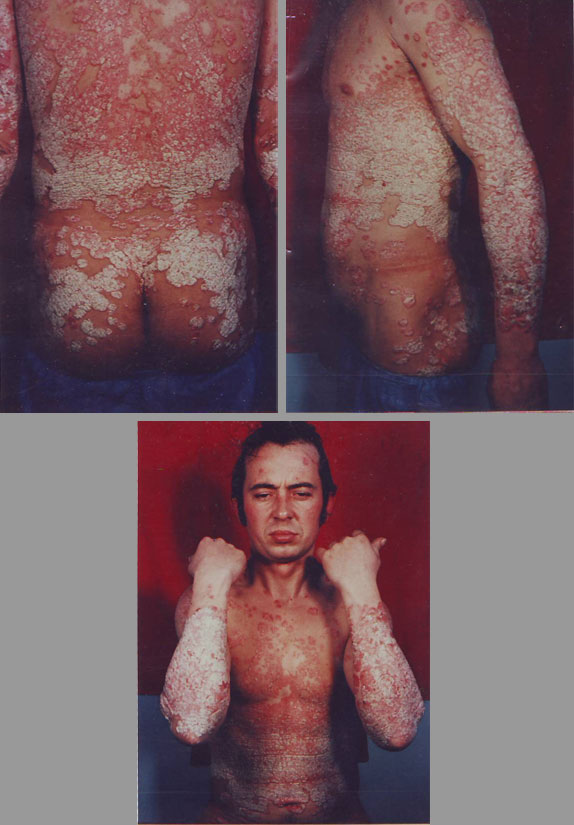 Psoriazis