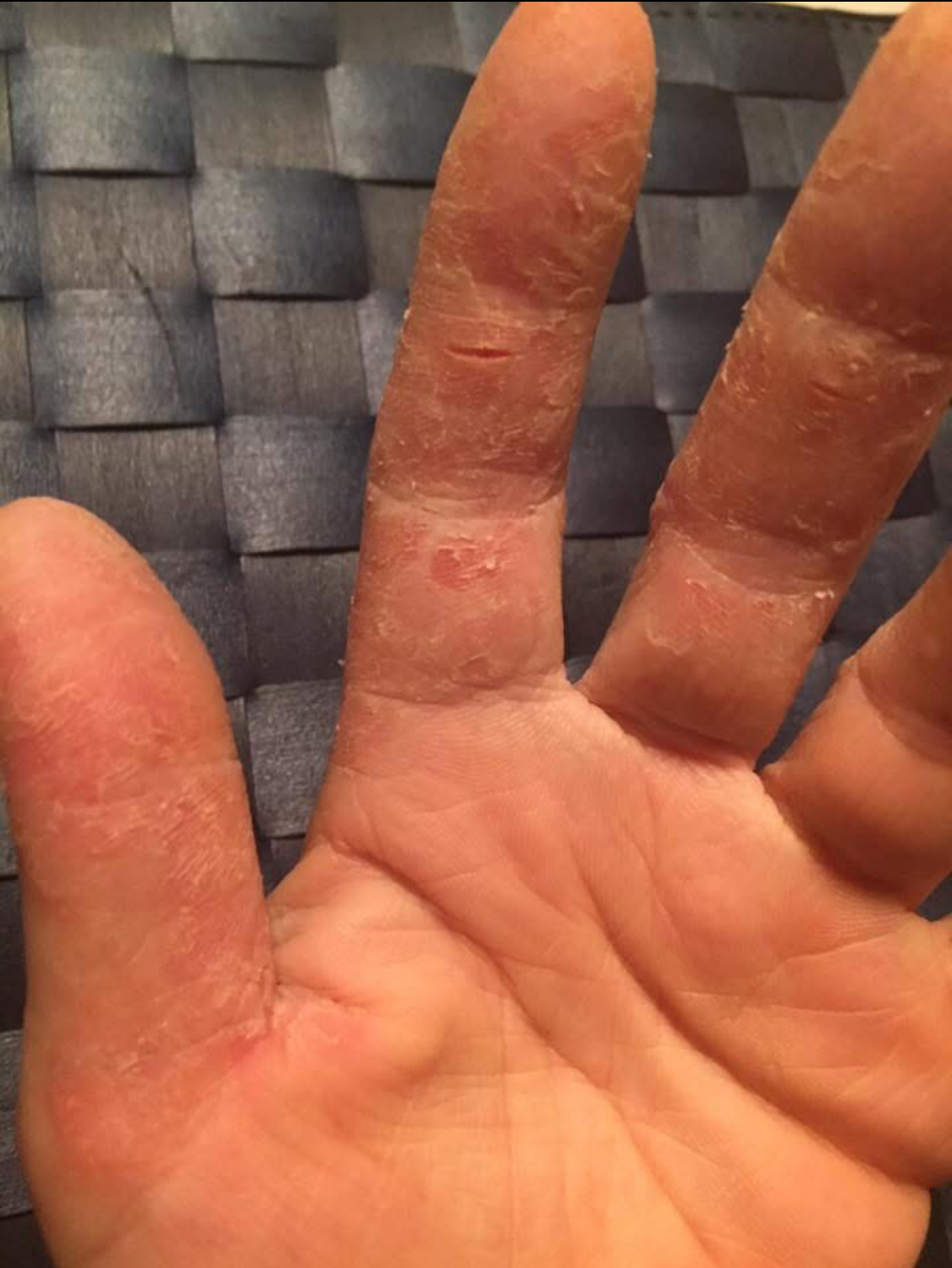 Eczema și Lichenul Plan