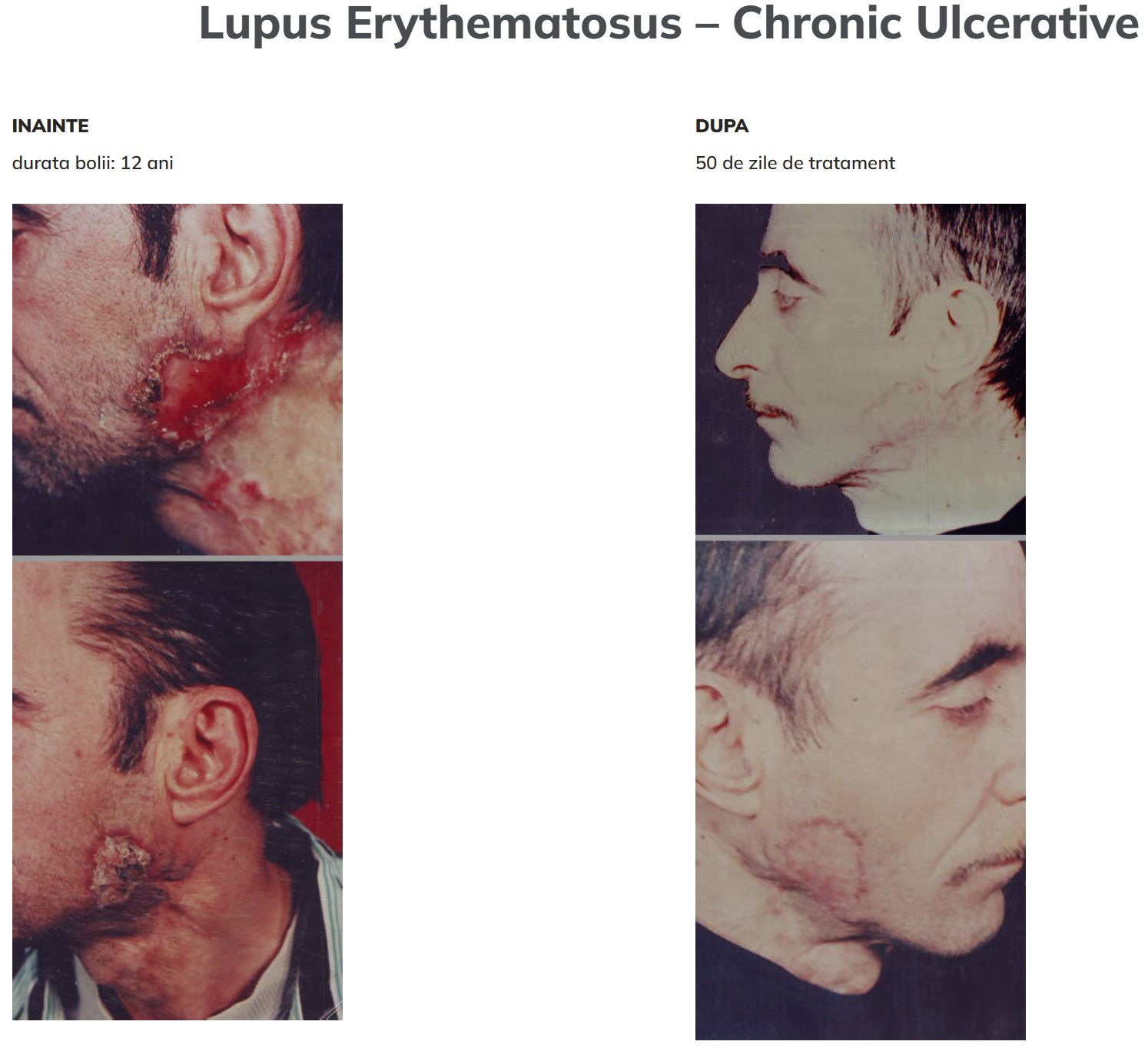Lupus eritematos cronic ulcerat