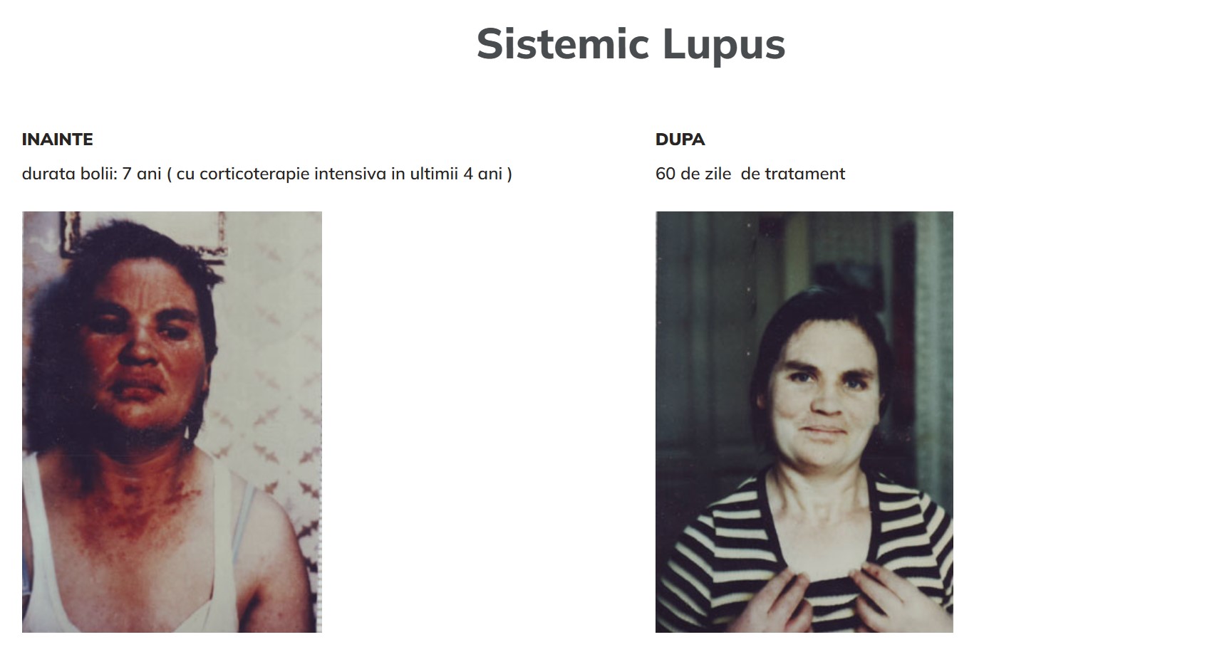 Lupus sistemic